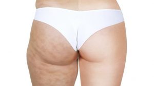 vencer a celulite gordura localizada